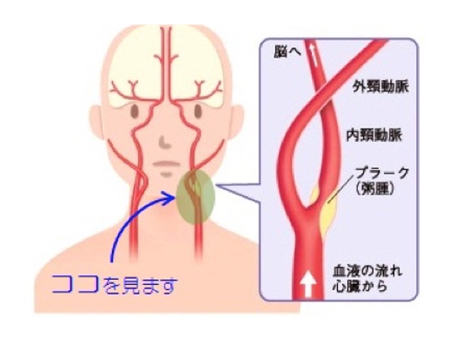 頸動脈エコー検査