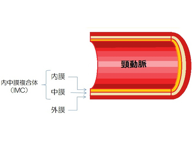 頸動脈エコー検査