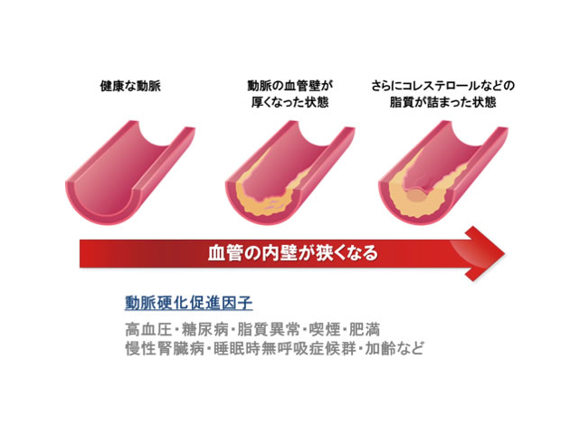 頸動脈エコー検査