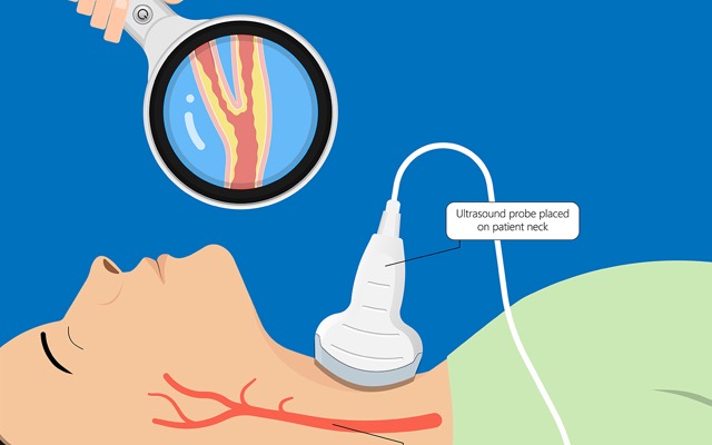 頸動脈エコー検査