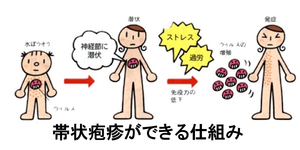 帯状疱疹ができる仕組み